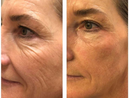 Aparelho de Lifting Facial Microfocado Reparador de Linhas de Expressão - Derma Lift + Máscara Facial Grátis
